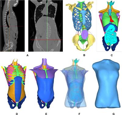 Determination of Three-Dimensional Corrective Force in Adolescent Idiopathic Scoliosis and Biomechanical Finite Element Analysis